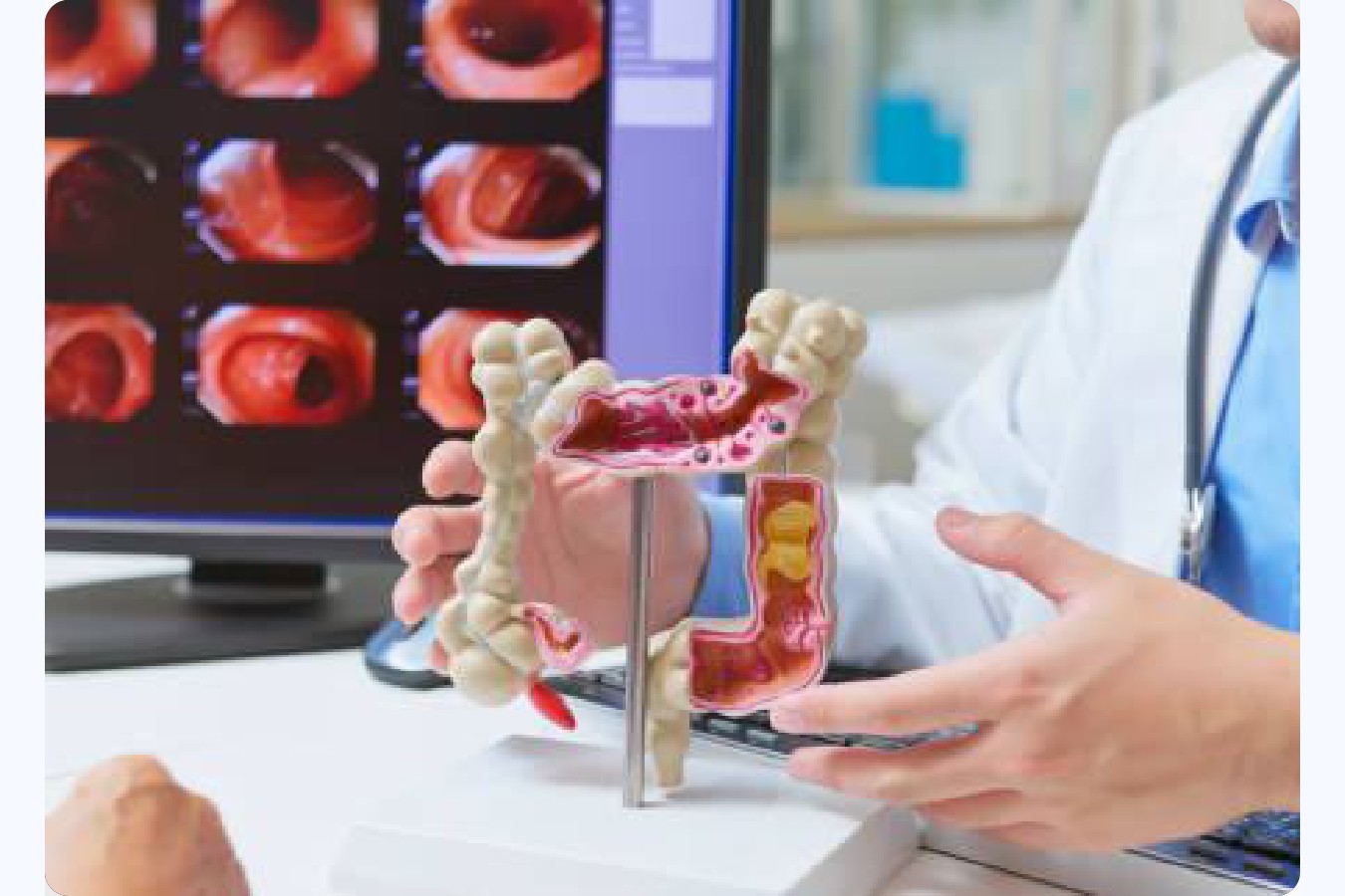 Síntomas del cáncer de colon
